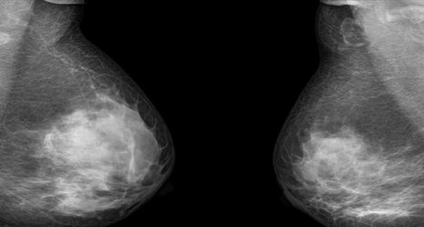 Breast cancer blood test could help to spot relapse earlier