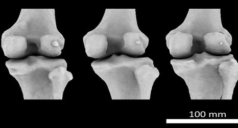 Mystery arthritis-linked knee bone three times more common than 100 years ago